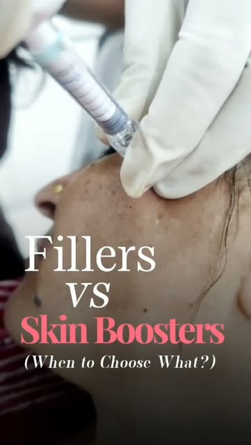 Fillers vs Skin Boosters 💉✨

Same syringe? NO. Same goal? Definitely NOT!

💎 DERMAL FILLERS
Think 