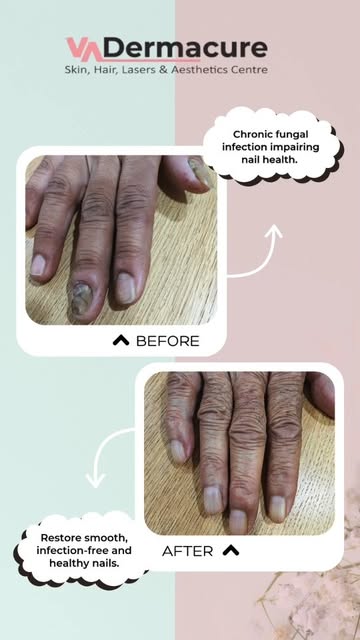Are you suffering with FUNGAL INFECTION of nails??

Fungal infections of the skin/nails are common—b