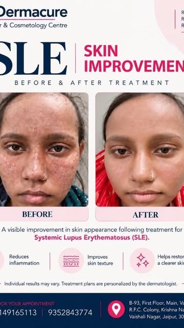 ✨ SLE — Before & After ✨

A visible improvement, but every case of Systemic Lupus Erythematosus (SLE