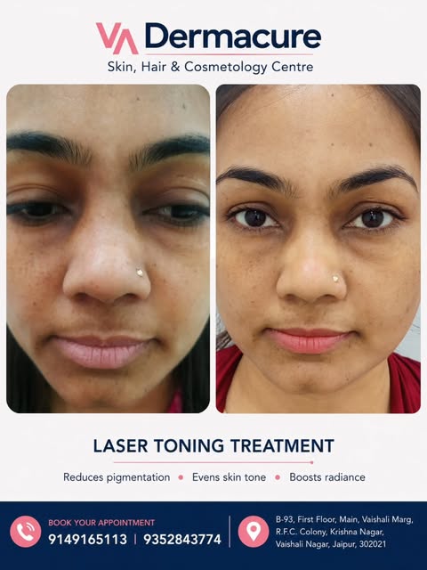 ✨ LASER TONING RESULTS ✨

Brighter. More Even. More Radiant. ✨

Laser toning can help improve: 

• P
