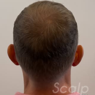 👑 SMP Crown Density Fill

Thinning at the crown doesn’t have to define your look. SMP Crown Density