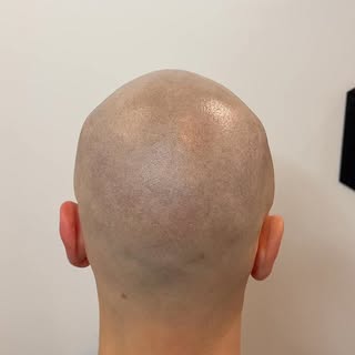 Igale probleemile on lahendus.

🔥 Tulemus pärast 3 SMP seanssi – loomulik raseeritud pea efekt, ter