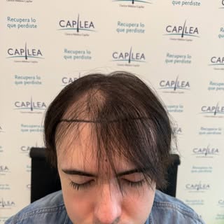 Resultado post implante capilar técnica FUE de alta densidad 

alopecia grado 5 

📍 @capileachilesa