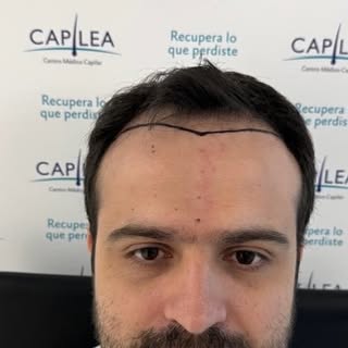 6 meses post implante capilar | alopecia Norwood IV-A ✨

Una evolución que comienza a mostrar el pot