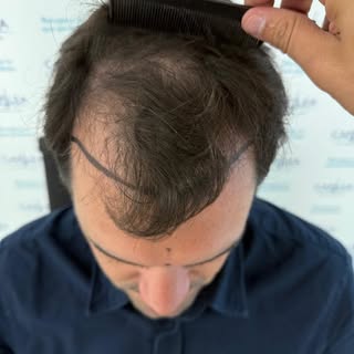 ✨ Control a los 9 meses post implante capilar, 4521 unidades foliculares ✨

Se aprecia una  buena de