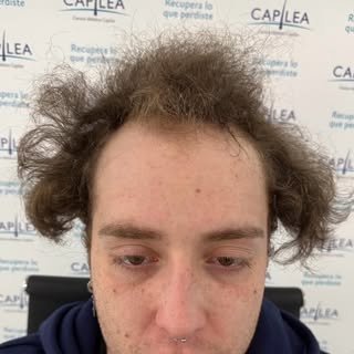 1 año después del implante capilar ✨

Evolución de un caso de alopecia Norwood III Vertex, con recup
