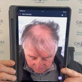No se trata solo de recuperar cabello. Se trata de recuperar confianza. 🙌🏻

Después de 1 año, el c