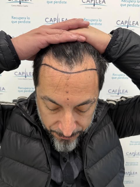 🔥 ¡1 AÑO DESPUÉS Y EL CAMBIO HABLA POR SÍ SOLO!

Alopecia Norwood IV Vertex ➜ más densidad, cobertu