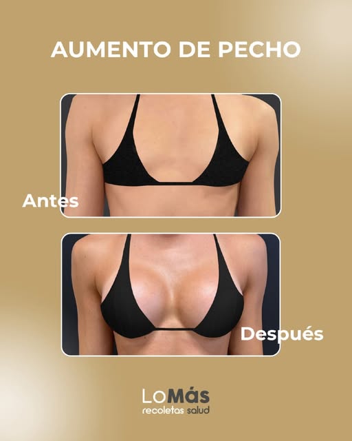 ✨ Un resultado que habla por sí solo.

Te mostramos el antes y después de un aumento de mama realiza
