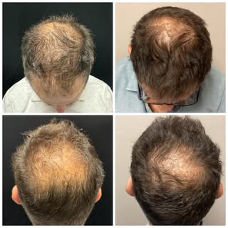 These before pictures, on the left, were taken in January. The after pics are from TODAY!😍 

Our Al