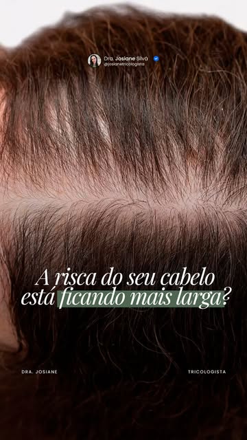 Nem toda perda capilar começa com muito cabelo caindo.

Em muitas mulheres, o primeiro sinal aparece