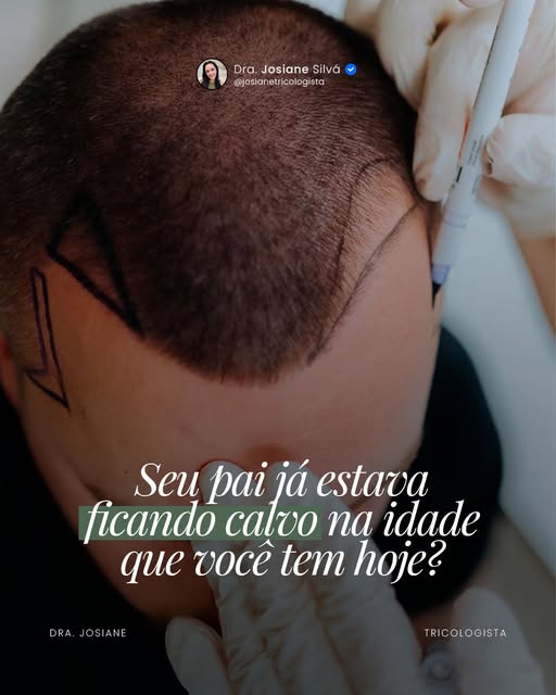 Talvez você nunca tenha feito essa conta.

Com quantos anos seu pai começou a perder cabelo? E com q