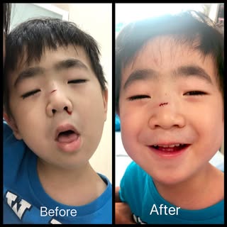After 4 stitches, Smiling Damon is back😍 “I’ll be more careful next time.” said Damon