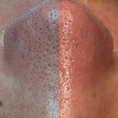 Before & after hydradermabrasion 🫧

Vergoeding vanuit zorgverzekering 
Wij zijn gecertificeerd in a