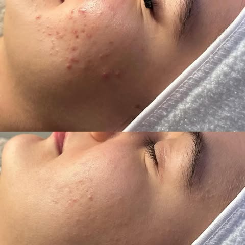 Acne? Geen paniek—er zijn oplossingen 👩🏻‍⚕️🖤

Na 2 behandelingen al zichtbaar verschil 
De huid o