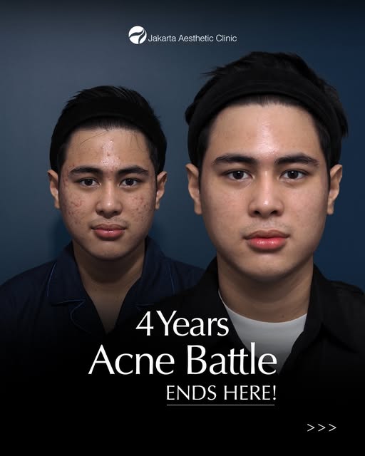 4 years of acne, gone with just 2 treatments ✨

“Finally, I can say goodbye to acne. Ternyata ga per