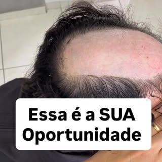 Você está cansado da calvície? Resolva AGORA!

A prótese capilar te entrega um visual novo no mesmo 