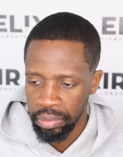 Small but effective Side profile/hairline reconstruction case 

SMP can be used is many effective wa