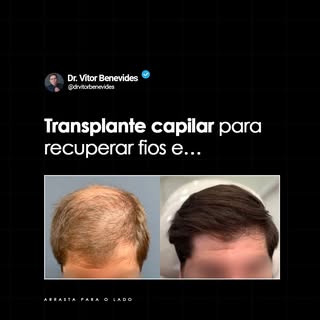 CONTEÚDO PATROCINADO | O tratamento à calvície com um médico cirurgião especialista, aqui mesmo em B