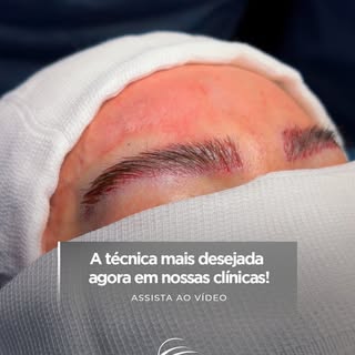 O Long Hair acaba de chegar às nossas clínicas e eleva completamente o padrão dos resultados em sobr