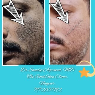 #pigmentation #pigmentationremoval