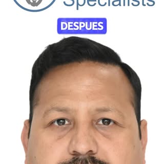 Cambios visibles, resultados medibles

📸 Swipe 👉 para ver el antes y después de un paciente con lí