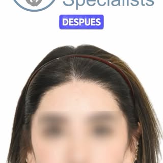 💫 TRANSFORMACIÓN REAL: Injerto capilar femenino 💫

El injerto capilar no es solo para hombres — ta