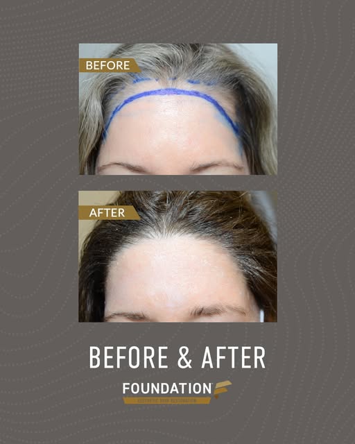 Before and after 1,500 grafts. Done to show hairline refinement. Hair grafting was chosen over hairl