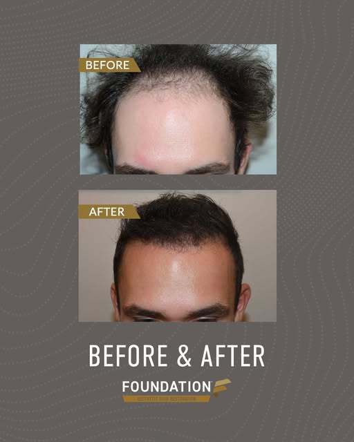 Before and after 2,650 FUE grafts on this 39 year-old-patient. He desired a fuller appearance.

Call