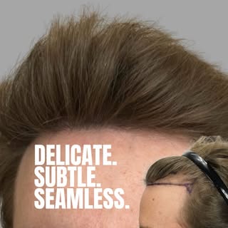 Delicate. Subtle. Seamless
And completely undetectable. 👌

💥 This 1500 graft FUE surgery performed