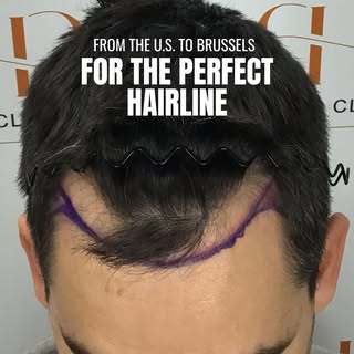 From the U.S. to Brussels for the perfect hairline! 🇺🇸➡️🇧🇪
⠀
This 36 year old patient crossed co