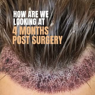 How are we looking at 4 months? 

This patient presents just 4 months after a 2003 graft frontal res