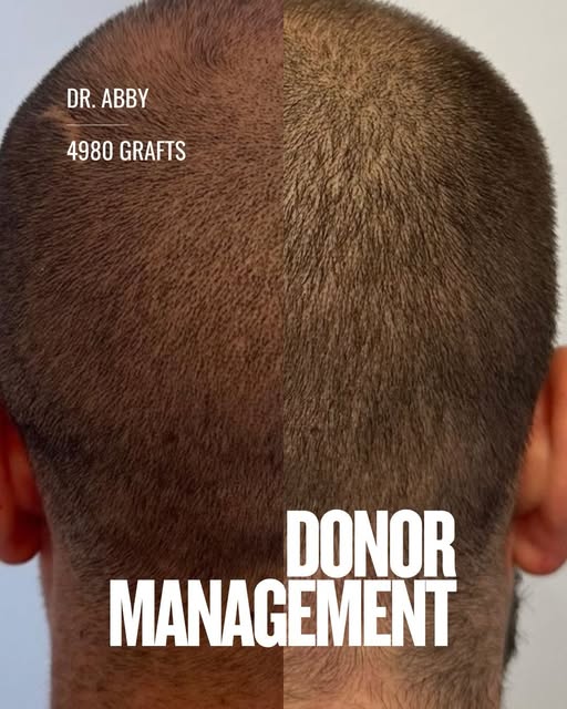 DONOR MANAGEMENT MATTERS.

When people assess a hair transplant, almost all of the attention goes to