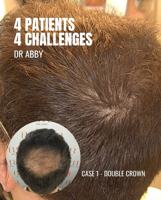 4 patients. 4 different challenges.

No two hair restoration cases are the same. Each patient presen