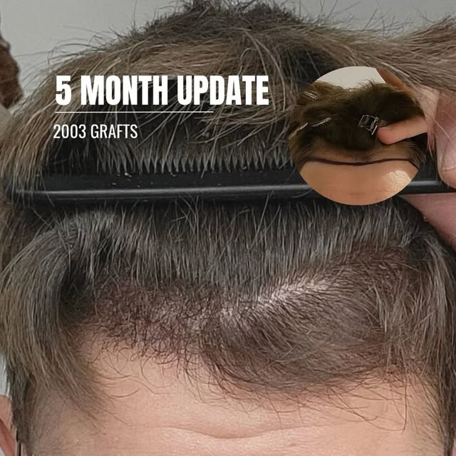 5 MONTHS | 2,003 GRAFTS | PATIENT UPDATE

A five-month update shared independently by our patient on