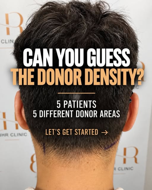 CAN YOU GUESS THE DONOR DENSITY? 👀

Five patients. Five different donor areas.

These measurements 