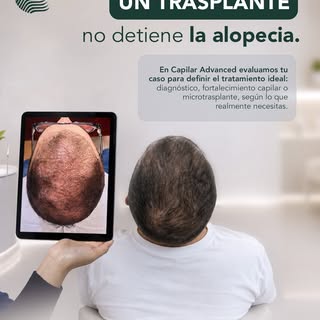 ✨ Un trasplante no detiene la alopecia.

El trasplante capilar ayuda a recuperar zonas donde ya hubo