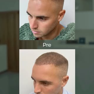 La diferencia también está en cómo vives el proceso ✨

En Evolve Care, el microtrasplante capilar co