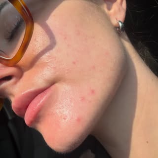 Starting retinol and suddenly breaking out? It might be purging—not your skin getting worse.

Retino