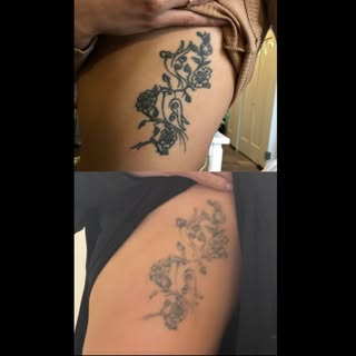 7 Tattoo Removal Sessions ✨

This is the progress after 7 laser tattoo removal treatments, with each