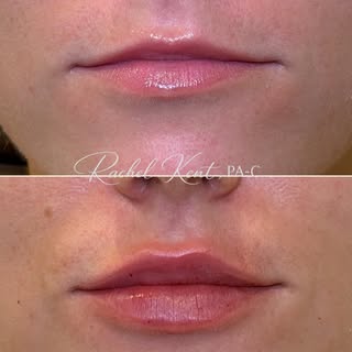 We love a mini lip 👄  On special for $400 for the month of August!
Mini lip: up to 1/2 syringe depe