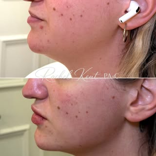 Facial balancing with jawline contouring 🫶🏼
Free consultations available to determine candidacy.

