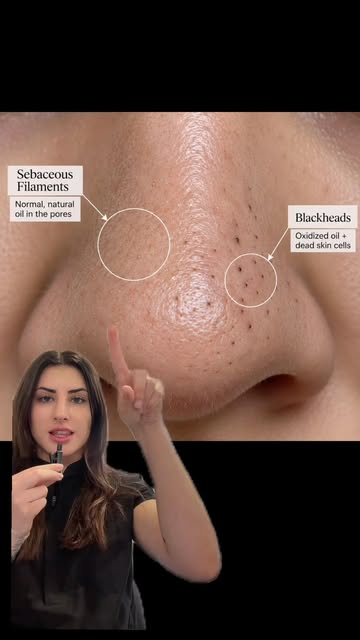 How do I treat congestion? 

✨ Gentle cleanser + silicone scrubber once a day
✨ Double cleanse start