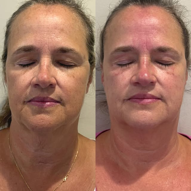 Before and afters that speak for itself! 
This is my beautiful client two months after just ONE radi