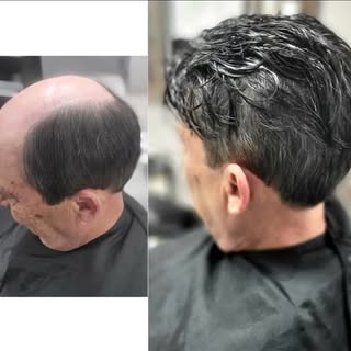 Implante bem aplicado , acabamento perfeito ! 
 #autoestima #protesecapilarmasculino #calvice #belez