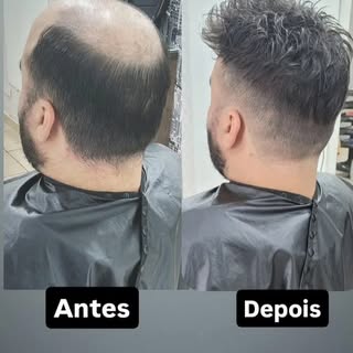 Mudança de visual impactante ! 
#antesedepois #protesecapilarmasculino #transformação #calvice #auto