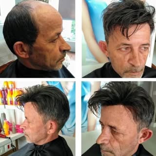 Mudar o visual requer atitude e determinação ! 
#protesecapilarmasculino  #transformação  #calvice  