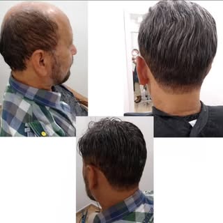 #antesedepois #protesecapilarmasculino #calvice #autoestima #micropele