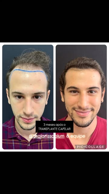 Pós-operatório de apenas três meses! Resultado maravilhoso em um paciente que, claramente, já está m