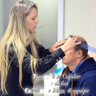 Mais um TRANSPLANTE CAPILAR de excelência! 12.200 fios implantados! #transplantecapilar #tecnicafue 